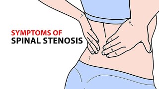 Symptoms of Spinal Stenosis [upl. by Stephenie]