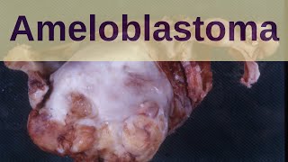 Ameloblastoma  Pathology mini tutorials [upl. by Shepley]