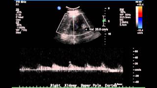 Duplex Demonstration of Normal Renal Arterial Blood Flow  Case Study [upl. by Sibyls]