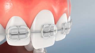 Incisor Eruption for Perio [upl. by Orran]