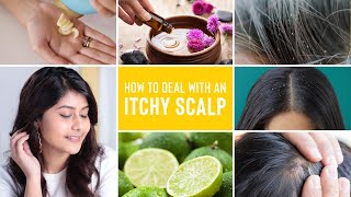 Itchy Scalp Treatments  Remedies For Dandruff Lice and Scalp Acne [upl. by Aileda82]