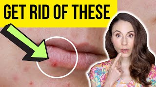 HOW TO GET RID OF LIP PIMPLES FAST  Dermatologist [upl. by Isnam]