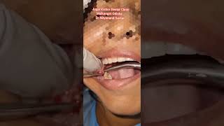 Surgical extraction of lower right third molarwisdom tooth painful last vestigial tooth removal [upl. by Atalaya]