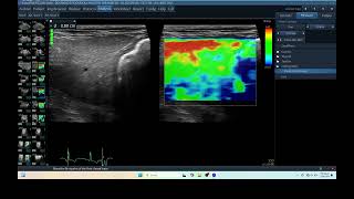 IQ 277 LIVER ELASTOGRAPHY HEPATOMA ECHOPAC ANALYSIS ULTRASOUND [upl. by Jessabell]