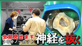 【 全部見せます 】ズキズキ痛む歯を治す！３０分ノーカット！根管 根幹 歯医者 [upl. by Elaine]