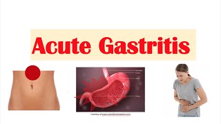 Acute Gastritis Stomach Inflammation  Causes Signs amp Symptoms Diagnosis Treatment [upl. by Bertelli]