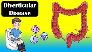 Diverticular Disease And Diverticulitis  Causes Signs amp Symptoms Diagnosis Treatment [upl. by Aluin]