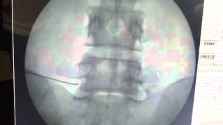 Ultrasound Guided Lumbar Transforaminal Epidural Injection [upl. by Shena]