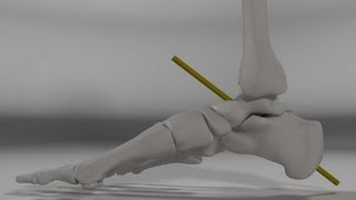 Over Pronation amp Supination Motion Biomechanics of the Subtalar Joint Explained [upl. by Ahsemak]