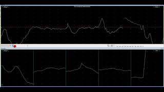 myotonic discharge [upl. by Rofotsirk]