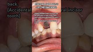 Front teeth Incisor root canal loose crown extraction procedure implant placed amp zirconia tooth [upl. by Ahsurej]