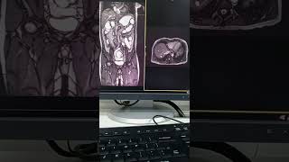 Mri enterography first time nakagawa nito [upl. by Eylloh]