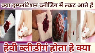 Kya Implantation bleeding me clots aate hai।Heavy Bleeding hoti hai।Implantation Bleeding Vs Periods [upl. by Elledoj]