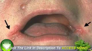 Cold Sores in the Corner of the Mouth  Have You Got Angular Cheilitis [upl. by Benoite]