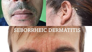 Seborrheic dermatitis  treatment health [upl. by Ogdan]