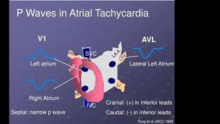 Atrial Tachycardia types and localization Dr Gehad Gamal [upl. by Descombes]