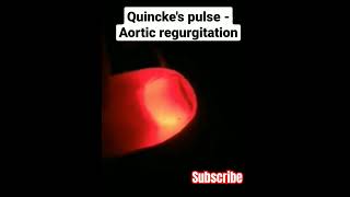 Quinckes Sign medicine clinical [upl. by Fenton882]