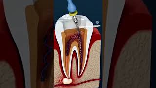 Root canal treatment for infected tooth STEP BY STEP rootcanal implantprocedure infectedtooth [upl. by Audre]