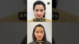 Hairline Transplant LoveShape 2 Weeks Result  GLOJAS AESTHETIC CLINIC [upl. by Naes]