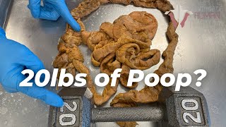 How Much Poop Is Stored in Your Colon [upl. by Sokul]