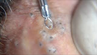 Blackheads Comedones  Behind extraction procedure [upl. by Adlesirk]