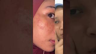 Dermatitis Perioral My experience 20232024 skincare dermatitis skimcarelokal [upl. by Aniahs522]