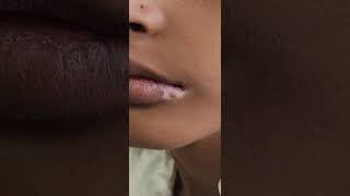 Lip vitiligo dr Bhutada Vitiligo Clinic [upl. by Sammons]