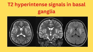 T2 hyperintense signals in basal ganglia [upl. by Ailisab]