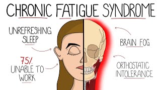 Myalgic Encephalomyelitis Chronic Fatigue Syndrome  Includes Criteria amp Treatment [upl. by Netsriik]