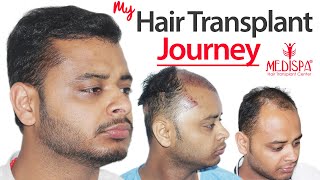 Hair Transplant in India  Combine FUTFUE INDIA  RESULTS  Higher Grade  MEDISPA  Dr Suneet Soni [upl. by Cati914]