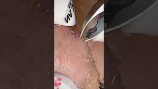 Skincare  Blackheads Removal 192 skincare skincare blackheads blackheads [upl. by Dielu]