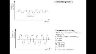 Kussmaul Breathing Diabetic Ketoacidosis [upl. by Corbin]