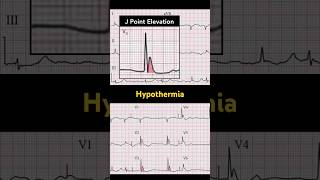 Hypothermia ECG J point elevation [upl. by Siro]