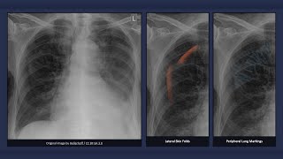 Pneumothorax Lookalike Lateral Skin Folds Chest Xray [upl. by Adnofal]