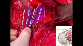 LUMBOSAKRAL PLEXUS VE PELVİK YAN DUVAR ANATOMİSİ LUMBOSACRALPLEXUS PELVICSIDEWALLANATOMY [upl. by Eelan473]