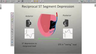 Localizing Ischemia on the ECG [upl. by Ayatnahs]