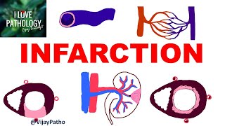 INFARCTION Causes Types Morphology [upl. by Aliakim]