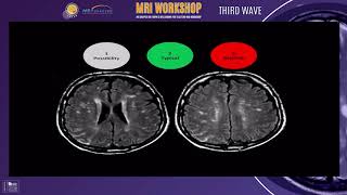 Supratentorial MS lesions  ESNPN Worshop Arabic [upl. by Alethea]