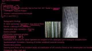 97P What is Ankylosing Spondylitis [upl. by Noyad]