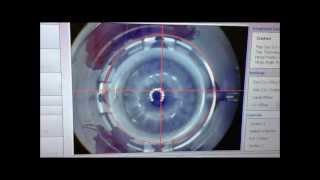 LASIK 100 laser with custom elliptical flap for astigmatism correction [upl. by Elac682]