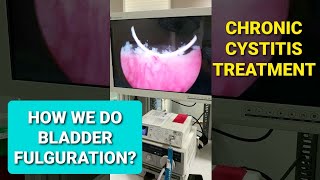 Urinary Tract Infection Chronic Recurrent Cystitis Treatment BLADDER FULGURATION [upl. by Naitirb]