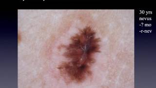 Recurrent nevus or melanoma  Dr Andreas Blum [upl. by Oringa]