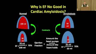 ATTR Cardiac Amyloidosis Treating the Symptoms [upl. by Lotty]