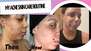 MY ACNE SKIN ROUTINE [upl. by Ahab804]