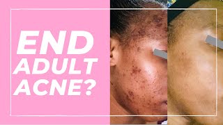 How to Get Rid of Pimples in Black Skin Best Pro Treatments [upl. by Luapnaej863]