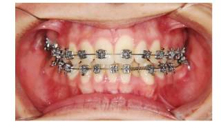 Self Ligating Braces dental Crowding Orthodontics [upl. by Myrvyn]