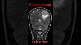 Glioblastoma shorts radiology mribrain radiologyjunction [upl. by Aihcrop611]