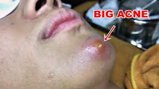 BIG ACNE ON CHIN [upl. by Altaf]