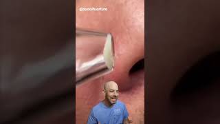 I wouldn’t recommend a pore vacuum 🛑 credit zudaifuarturo on TT doctor satisfying viral [upl. by Introc435]