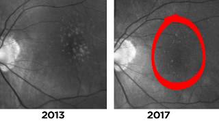 Two Cases of Disappearing Drusen in Patients with AMD [upl. by Tonya]